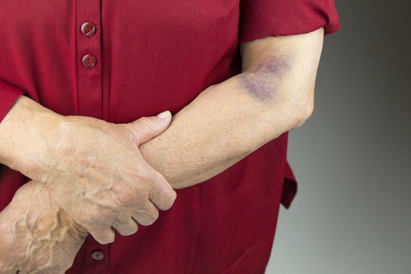 Arm bruise