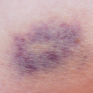 purple colored bruise