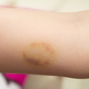 yellow colored bruise on an arm