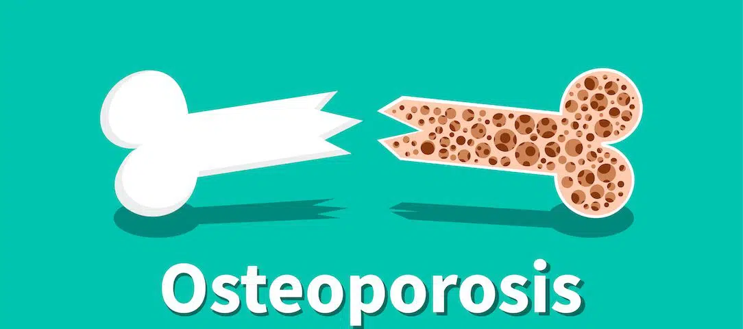 can-you-prevent-osteoporosis-while-youre-young