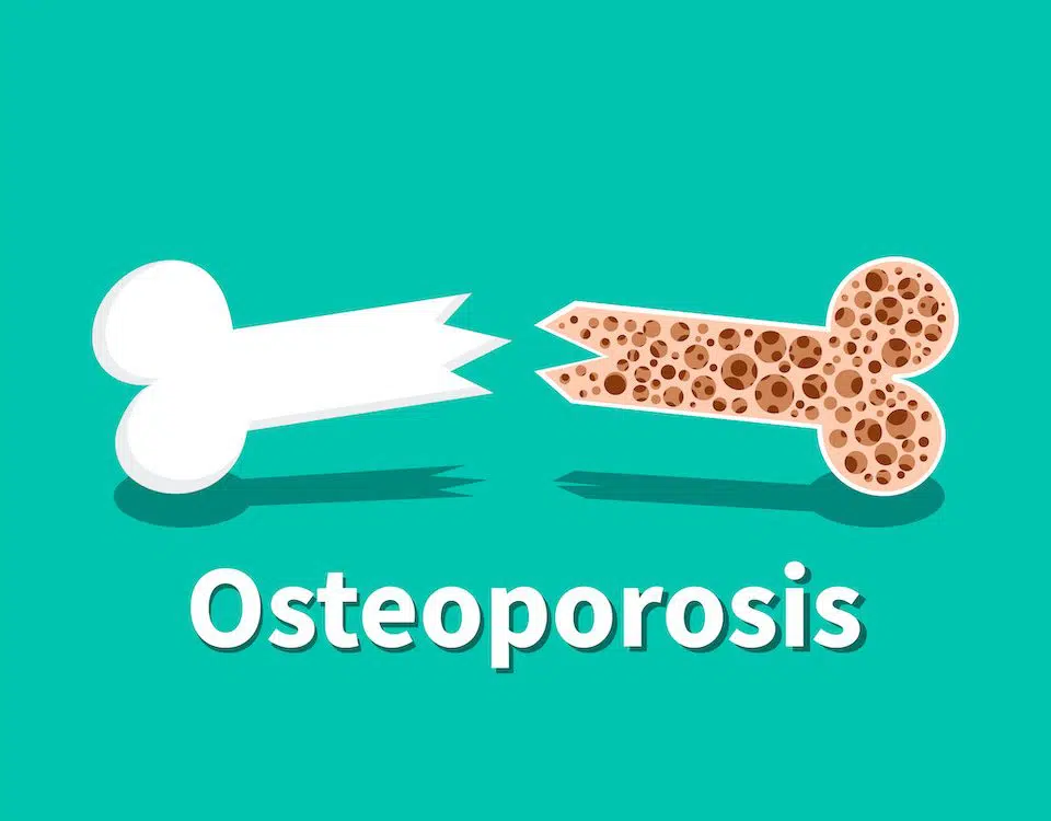 can-you-prevent-osteoporosis-while-youre-young