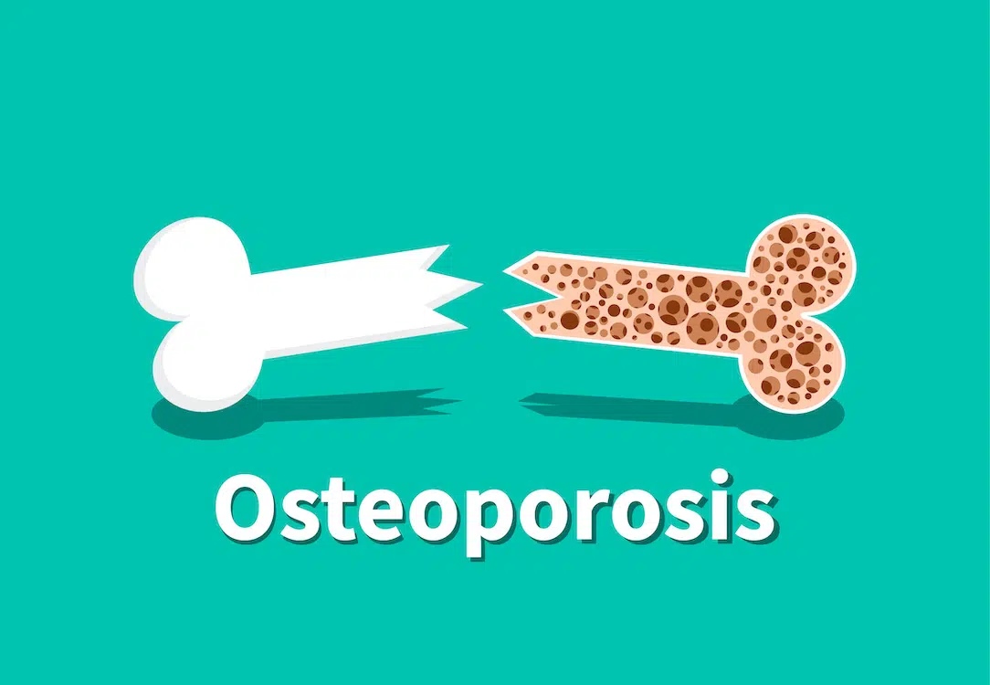 can-you-prevent-osteoporosis-while-youre-young