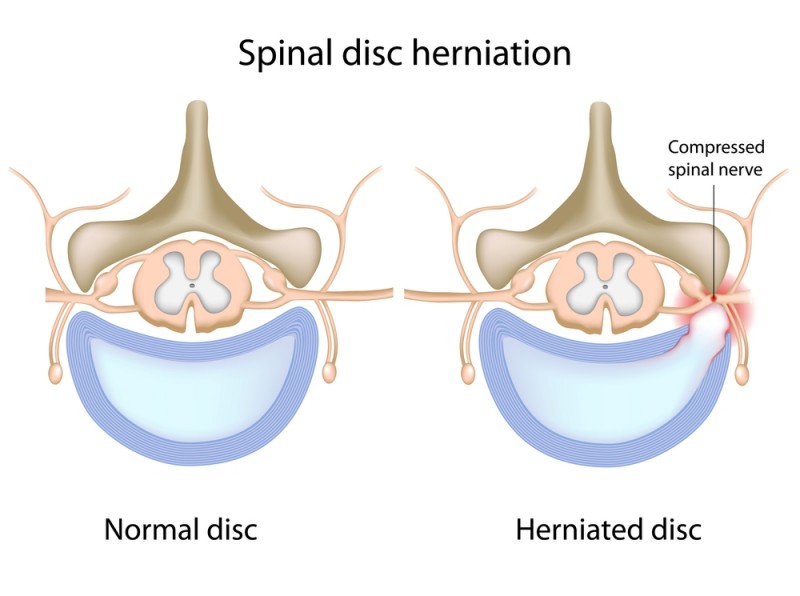 Herniated Disc Diagram