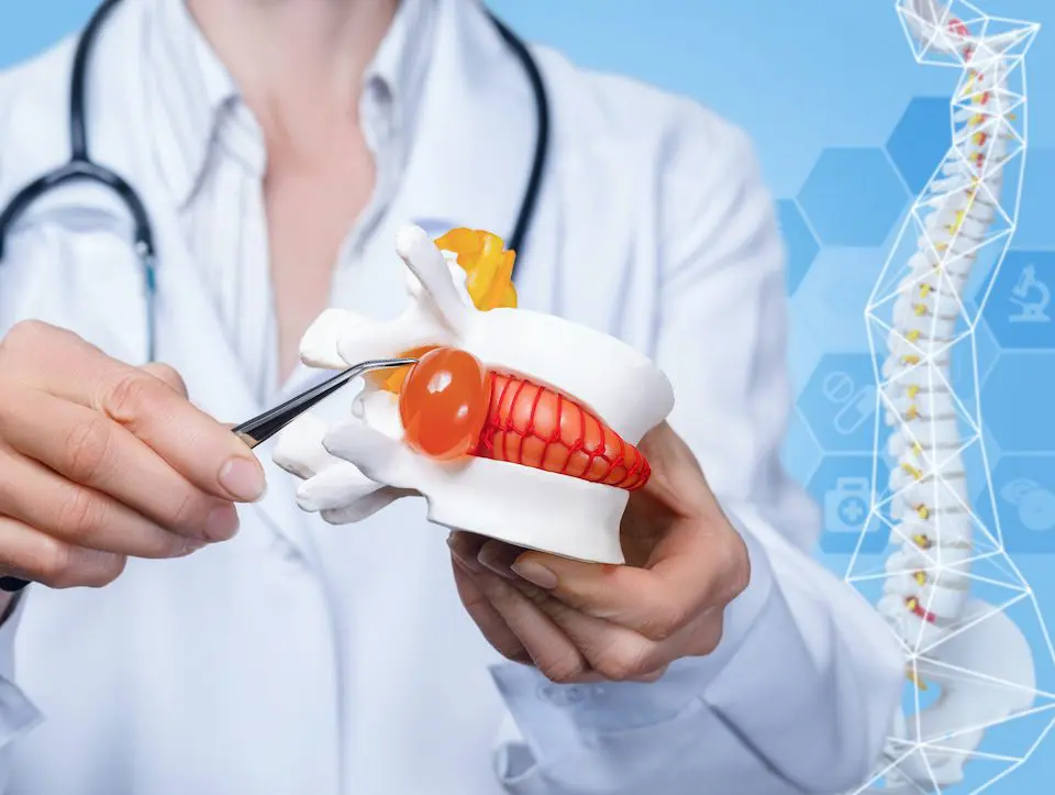 what-to-know-about-herniated-discs