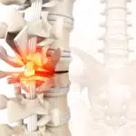 what-to-know-about-spinal-compression-fractures