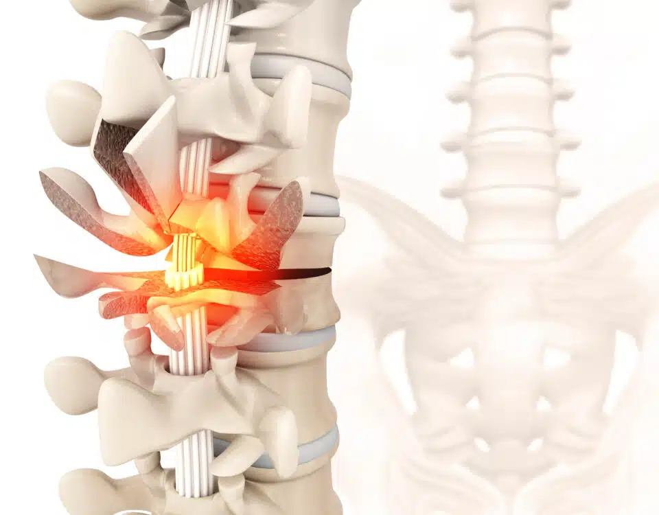 what-to-know-about-spinal-compression-fractures