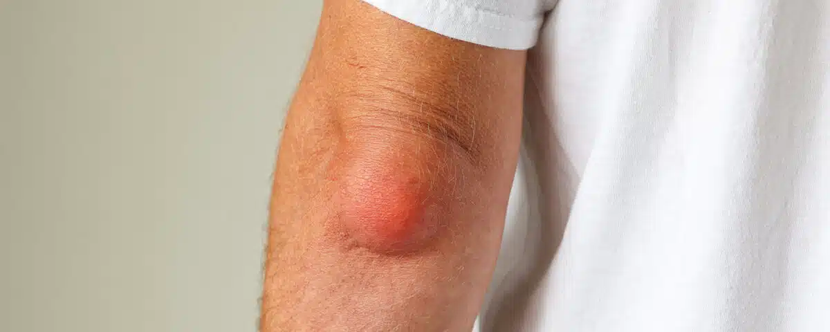 when-to-see-texas-spine-sports-therapy-center-for-bursitis