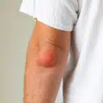 when-to-see-texas-spine-sports-therapy-center-for-bursitis